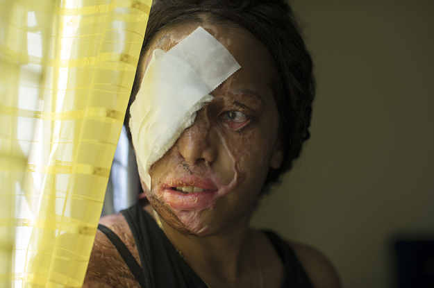 A 19-Year-Old Acid Attack Survivor Whose Case Led To Worldwide Outrage Is Ready To Tell Her Story